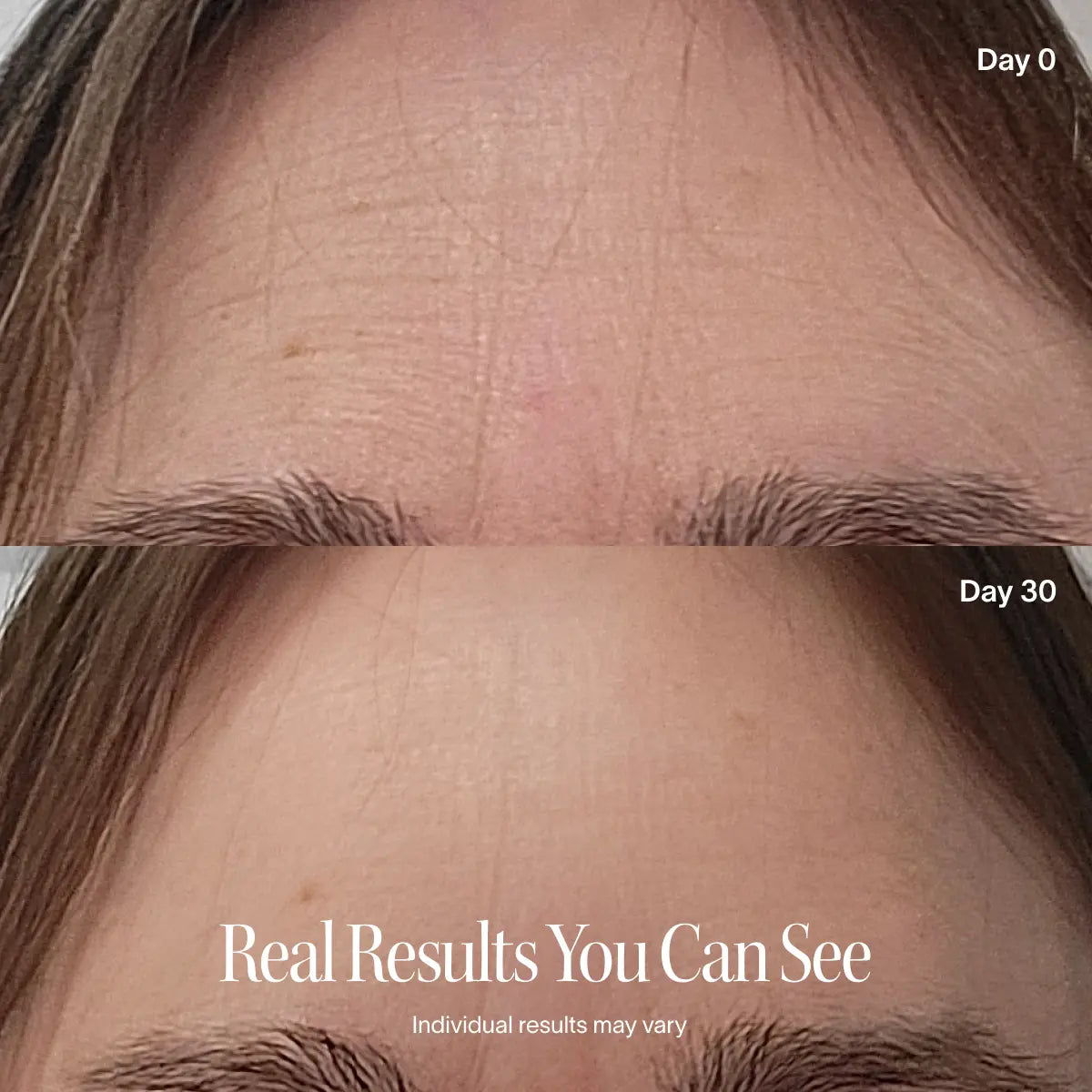 before-after ||Close-up of a forehead on day 0 (top) with lines, and on day 30 (bottom) after using the Solawave Wrinkle Retreat Pro LED Face Mask—showing smoother, younger-looking skin. Text: “Real Results You Can See. Individual results may vary.”.
